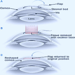 Are There Limits to Laser Refractive Surgery after Midlife? - Harvard  Health Publications - Harvard Health